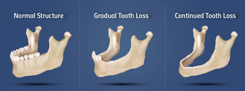 Are You Experiencing Bone Loss Around Your Teeth?