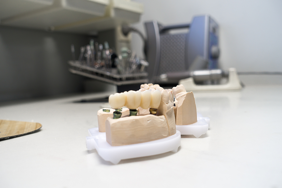 What to Do if Your Implant Crown Becomes Loose or Breaks