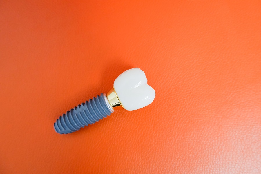 How Much Do Dental Implants Really Cost?