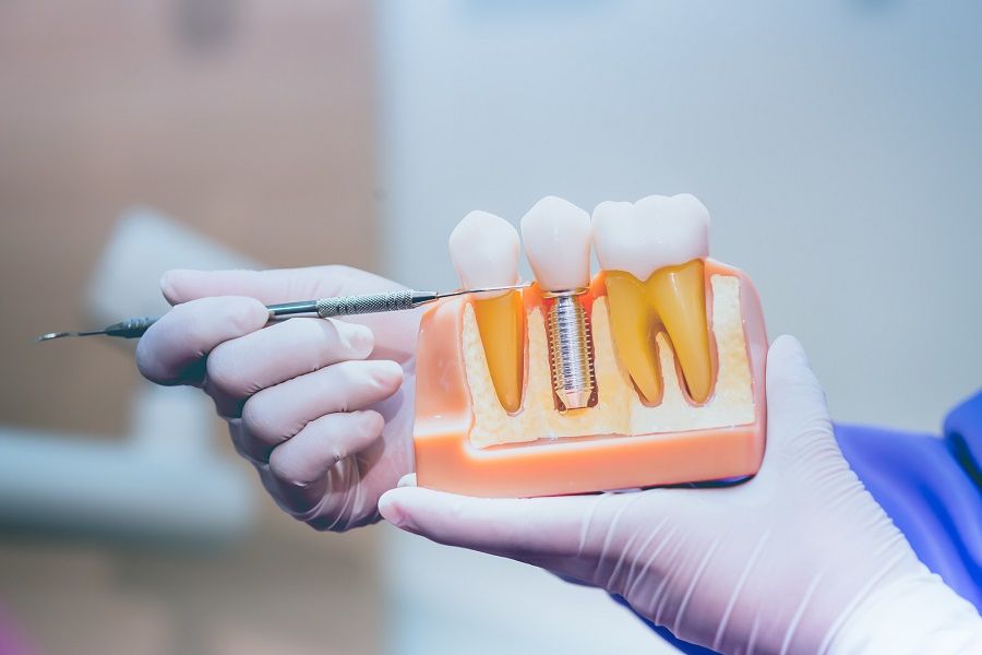 How Can I Tell If My Dental Implant Is Failing?